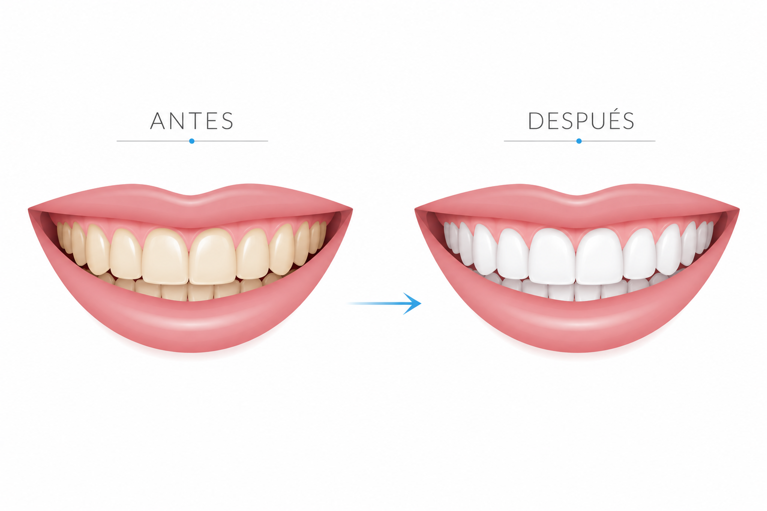 Kit blanqueador dental